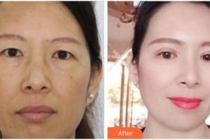 紹興愛爾眼科醫(yī)院史皞整形價(jià)格表附切開雙眼皮案例展示