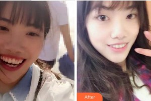 紹興越中口腔醫(yī)院陳琳整形價(jià)格表附牙齒陶瓷矯正案例展示