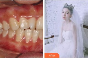 紹興京韓口腔醫(yī)院董立志整形價(jià)格表附牙齒隱形矯正案例展示