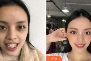 紹興柯橋口腔醫(yī)院張祥鋒整形價格表附隱形托槽矯正案例展示