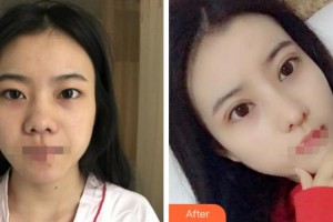 紹興市柯橋區(qū)中醫(yī)醫(yī)院眼科李偉整形價格表附切開雙眼皮案例展示