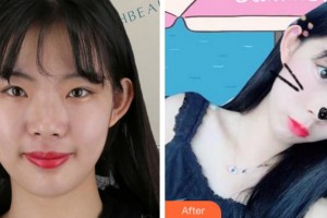 江蘇省蘇北人民醫(yī)院整形美容中心黃金華整形價格表附熱瑪吉案例展示