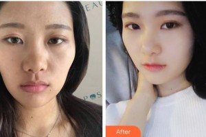 金華芘麗芙（原華美）整形醫(yī)院張弘整形價格表附熱瑪吉案例展示