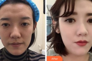 金華芘麗芙（原華美）整形醫(yī)院李信峰整形價(jià)格表附切開(kāi)雙眼皮案例展示