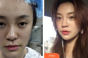 金華維多利亞美容醫(yī)院吳昌炎整形價(jià)格表附埋線提升案例展示