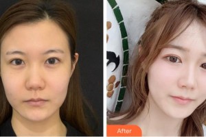 鄭州解放軍153中心醫(yī)院激光美容整形中心郭金華整形價(jià)格表附熱瑪吉案例展示