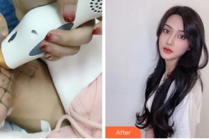 金華中心醫(yī)院整形美容中心童蕓整形價(jià)格表附熱瑪吉案例展示