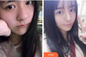 金華美辰醫(yī)療美容醫(yī)院嚴(yán)晟整形價(jià)格表附熱瑪吉案例展示