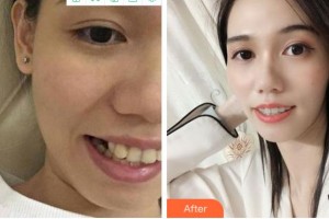 金華美辰醫(yī)療美容醫(yī)院涂強(qiáng)整形價(jià)格表附金屬托槽矯正案例展示