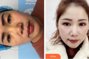 金華康美醫(yī)療美容綜合門診部孫傳整形價(jià)格表附定點(diǎn)雙眼皮案例展示