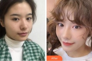 金華時(shí)光整形醫(yī)院邢恒峰整形價(jià)格表附埋線提升案例展示