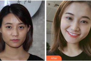 金華三星(原協(xié)和)整形醫(yī)院申鉉德整形價(jià)格表附埋線提升案例展示