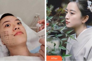 金華文榮醫(yī)院整形美容科林一奇整形價(jià)格表附熱瑪吉案例展示