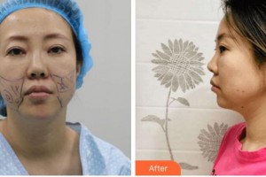 金華亞美整形美容醫(yī)院鄧澤臣整形價(jià)格表附埋線提升案例展示