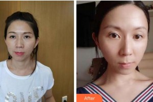 金華芘麗芙（原華美）整形醫(yī)院金凡穎整形價(jià)格表附熱拉提案例展示