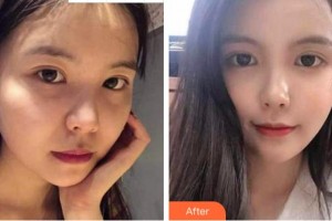 金華維多利亞美容醫(yī)院程煥武整形價(jià)格表附熱瑪吉案例展示