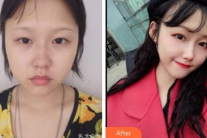 金華維多利亞美容醫(yī)院孫琦整形價(jià)格表附埋線提升案例展示