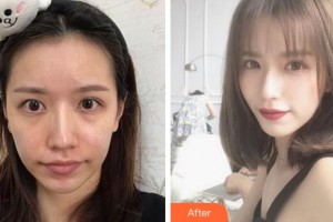 金華維多利亞美容醫(yī)院智海玲整形價(jià)格表附埋線提升案例展示