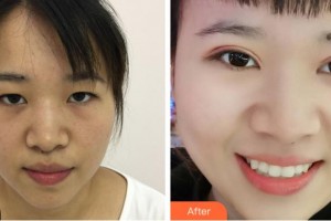 金華康美醫(yī)療美容綜合門診部劉興權(quán)整形價(jià)格表附定點(diǎn)雙眼皮案例展示