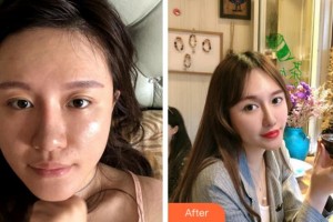 金華康美醫(yī)療美容綜合門診部洪鋼整形價(jià)格表附埋線提升案例展示