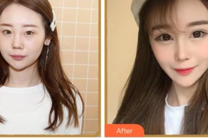 金華亞美整形美容醫(yī)院趙延嶺整形價(jià)格表附眼部綜合案例展示