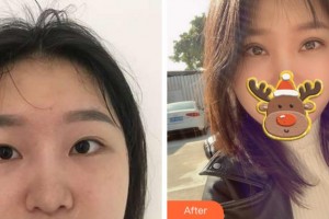 金華美辰醫(yī)療美容醫(yī)院胡華兵整形價(jià)格表附眼部綜合案例展示