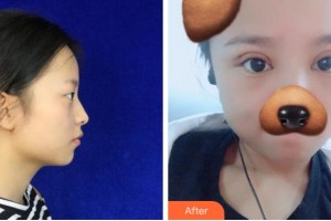 金華愛爾眼科醫(yī)院杜新華整形價(jià)格表附切開雙眼皮案例展示