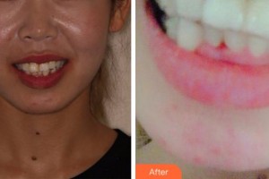 金華口腔醫(yī)院曹玲整形價(jià)格表附牙齒隱形矯正案例展示