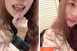 金華口腔醫(yī)院朱北蘭整形價(jià)格表附金屬托槽矯正案例展示