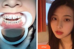 金華口腔醫(yī)院楊慶福整形價(jià)格表附隱形托槽矯正案例展示