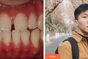 金華口腔醫(yī)院成曉敏整形價(jià)格表附金屬托槽矯正案例展示