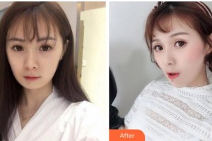 衢州民康醫(yī)院赫爾希整形美容中心胡謹(jǐn)整形價格表附埋線提升案例展示