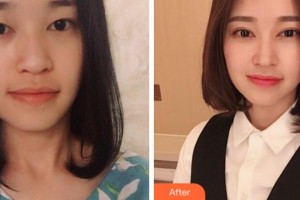 衢州芘麗芙整形美容醫(yī)院洪毓整形價格表附切開雙眼皮案例展示