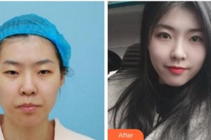 衢州芘麗芙整形美容醫(yī)院祝小平整形價格表附眼部綜合案例展示