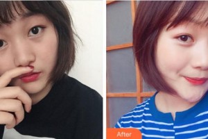 衢州芘麗芙整形美容醫(yī)院邢恒鋒整形價格表附熱拉提案例展示