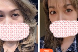 衢州美萊整形美容醫(yī)院王新杰整形價格表附內(nèi)切祛眼袋案例展示