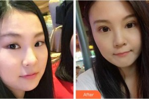 衢州芘麗芙整形美容醫(yī)院楊天明整形價格表附眼部綜合案例展示