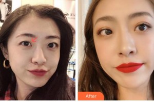 衢州愛爾眼科醫(yī)院荊樹棟整形價格表附眼部綜合案例展示