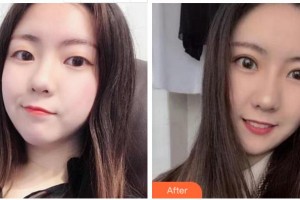 衢州愛爾眼科醫(yī)院張民軍整形價(jià)格表附切開雙眼皮案例展示