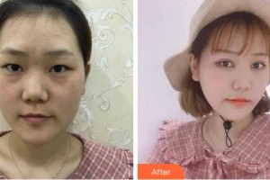 衢州愛爾眼科醫(yī)院麻張偉整形價(jià)格表附眼部綜合案例展示