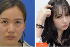 衢州愛爾眼科醫(yī)院李衛(wèi)整形價(jià)格表附激光去眼袋案例展示