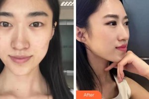 衢州市第二人民醫(yī)院眼科余曉峰整形價(jià)格表附眼部綜合案例展示