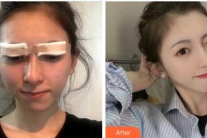 衢州市第二人民醫(yī)院眼科符建云整形價(jià)格表附切開雙眼皮案例展示