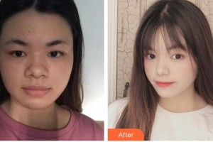 舟山妃斯醫(yī)療美容門診部李艷蓮整形價(jià)格表附埋線提升案例展示