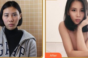 臺(tái)州新鳳凰醫(yī)學(xué)整形美容醫(yī)院陳國忠整形價(jià)格表附眼部綜合案例展示