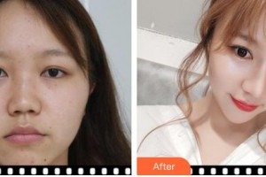 臺(tái)州新鳳凰醫(yī)學(xué)整形美容醫(yī)院井顯廉整形價(jià)格表附耳軟骨復(fù)合隆鼻案例展示