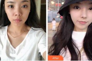 臺(tái)州博仕醫(yī)療整形美容醫(yī)院閆加鋒主診醫(yī)師整形價(jià)格表附肋軟骨隆鼻案例展示