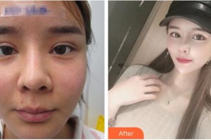 臺(tái)州博雅美惠醫(yī)療美容整形醫(yī)院張人波整形價(jià)格表附肋軟骨隆鼻案例展示