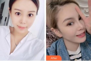 臺(tái)州維多利亞整形美容醫(yī)院王永展整形價(jià)格表附假體隆鼻案例展示