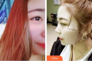 臺(tái)州維多利亞整形美容醫(yī)院王慶春整形價(jià)格表附超聲波潔牙案例展示